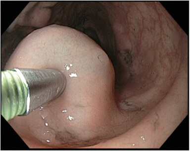 ASGEendoscopy's tweet photo. VideoGIE Editor's Choice: "Irreversible electroporation for treatment of colorectal cancer in a porcine model" by Manus Rugivarodom et al. Watch it here: https://t.co/PUOvVFOT5N #NCRCAM #GITwitter #VideoGIE https://t.co/MJIAM2luj6