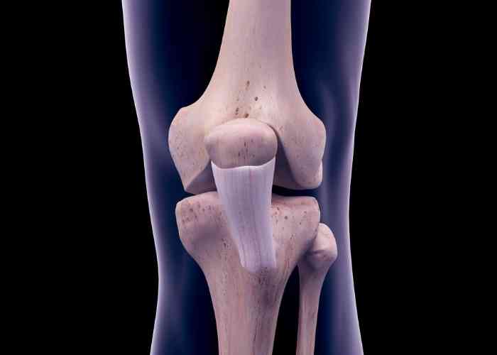 thekneedoc's tweet image. After a lateral patellar dislocation, an MRI can show:
🔍Tear of the Medial Patellofemoral Ligament
🔍Bone bruising or cartilage damage to the medial patella
🔍Bone bruising or cartilage damage to the lateral trochlear groove
medilink.us/awlz #kneeinjury #kneedislocation