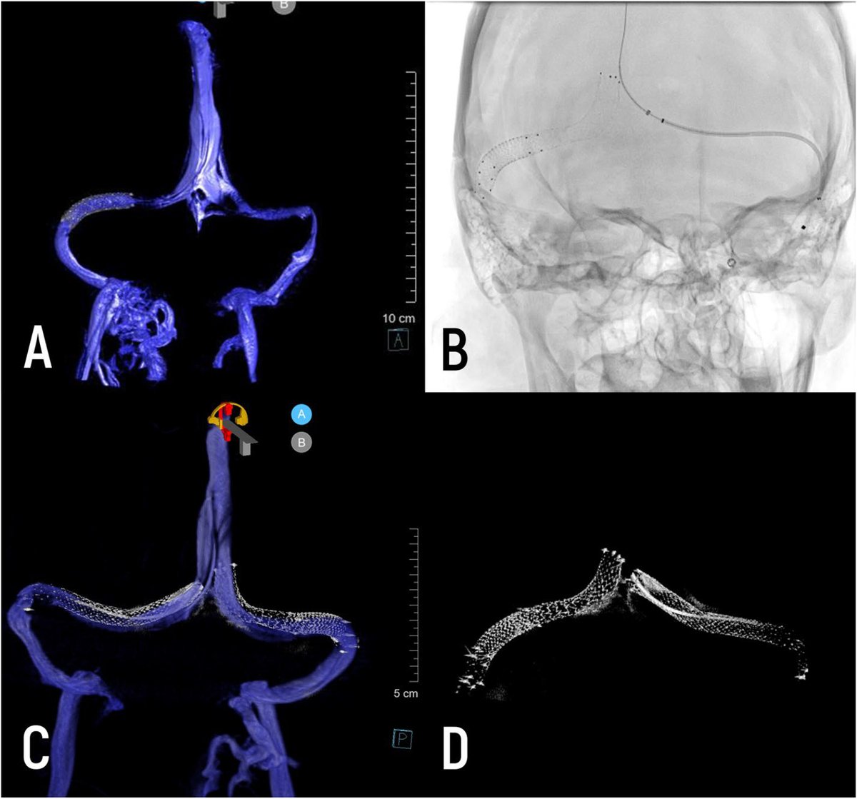 Penn Neurosurgery (@pennnsg) on Twitter photo New for <a href="/INR_WFITN/">Interventional Neuroradiology</a>, our cerebrovascular team presents cases that underwent advanced 3D rotational venography for the evaluation of idiopathic intracranial hypertension.
<a href="/visishs/">Visish M. Srinivasan, MD</a> <a href="/OlegShekhtman/">oSH</a> <a href="/JanKarlBurkhar1/">Jan-Karl Burkhardt, MD</a> <a href="/JCatapanoMD/">Joshua Catapano</a> <a href="/SnehaSaiMannam/">Sai Mannam</a> <a href="/GSSioutas/">Georgios Sioutas, MD</a>
➡️ spr.ly/6014078qy New for <a href="/INR_WFITN/">Interventional Neuroradiology</a>, our cerebrovascular team presents cases that underwent advanced 3D rotational venography for the evaluation of idiopathic intracranial hypertension.
<a href="/visishs/">Visish M. Srinivasan, MD</a> <a href="/OlegShekhtman/">oSH</a> <a href="/JanKarlBurkhar1/">Jan-Karl Burkhardt, MD</a> <a href="/JCatapanoMD/">Joshua Catapano</a> <a href="/SnehaSaiMannam/">Sai Mannam</a> <a href="/GSSioutas/">Georgios Sioutas, MD</a>
➡️ spr.ly/6014078qy