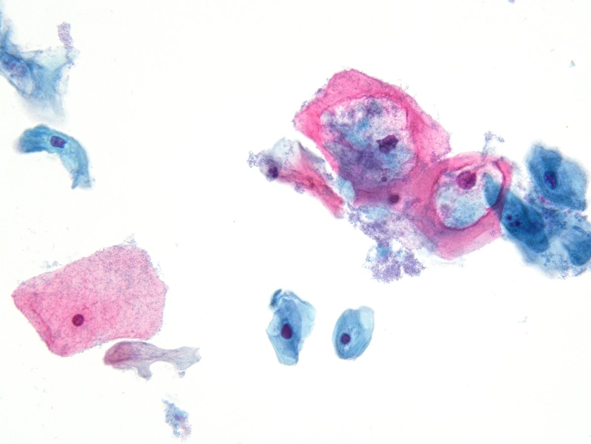 "Halos, wire loops and figure 8s" - All the right features for a textbook example of LSIL in a PAP test. (ThinPrep)