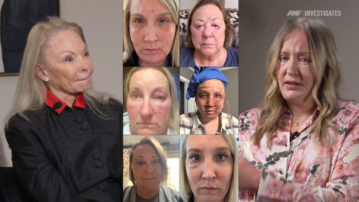 Lindsey Basye (@lindseybasye) on Twitter photo Multiple Atlanta women sue a local doctor accusing him of permanently ‘deformed,’ ‘scarred’ them -- <a href="/ATLNewsFirst/">Atlanta News First</a> Investigates the allegations. <a href="/CiaraCummingsTV/">Ciara Cummings</a> atlantanewsfirst.com/2025/03/24/atl… Multiple Atlanta women sue a local doctor accusing him of permanently ‘deformed,’ ‘scarred’ them -- <a href="/ATLNewsFirst/">Atlanta News First</a> Investigates the allegations. <a href="/CiaraCummingsTV/">Ciara Cummings</a> atlantanewsfirst.com/2025/03/24/atl…