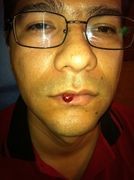 What is your diagnosis?  Answer = buff.ly/z4PKxyh