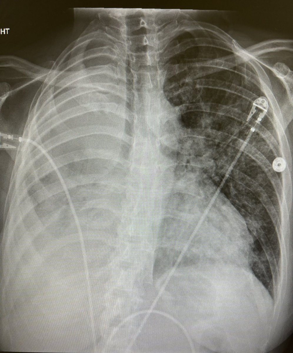 Reason #678376 why #pocus is essential to good medicine: Chest X-rays are not reliable enough. 

This is a patient with known lung cancer who presented to a hospital with acutely worsening hypoxic respiratory failure. They have a known large right lung mass. CXR: