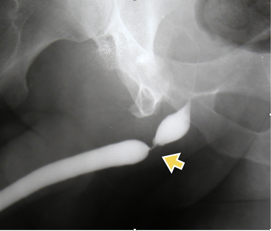 St. Luke's Health MD (@stlukeshealthmd) on Twitter photo Urethral strictures from trauma & inflammation impair quality of life for men. <a href="/bcm_urology/">BCM Department of Urology</a> & <a href="/StLukesHealthMD/">St. Luke's Health MD</a> lead a center of excellence offering urethroplasty with advanced tissue transfer - innovative & evidence-based solutions for complex urethral strictures. Urethral strictures from trauma & inflammation impair quality of life for men. <a href="/bcm_urology/">BCM Department of Urology</a> & <a href="/StLukesHealthMD/">St. Luke's Health MD</a> lead a center of excellence offering urethroplasty with advanced tissue transfer - innovative & evidence-based solutions for complex urethral strictures.