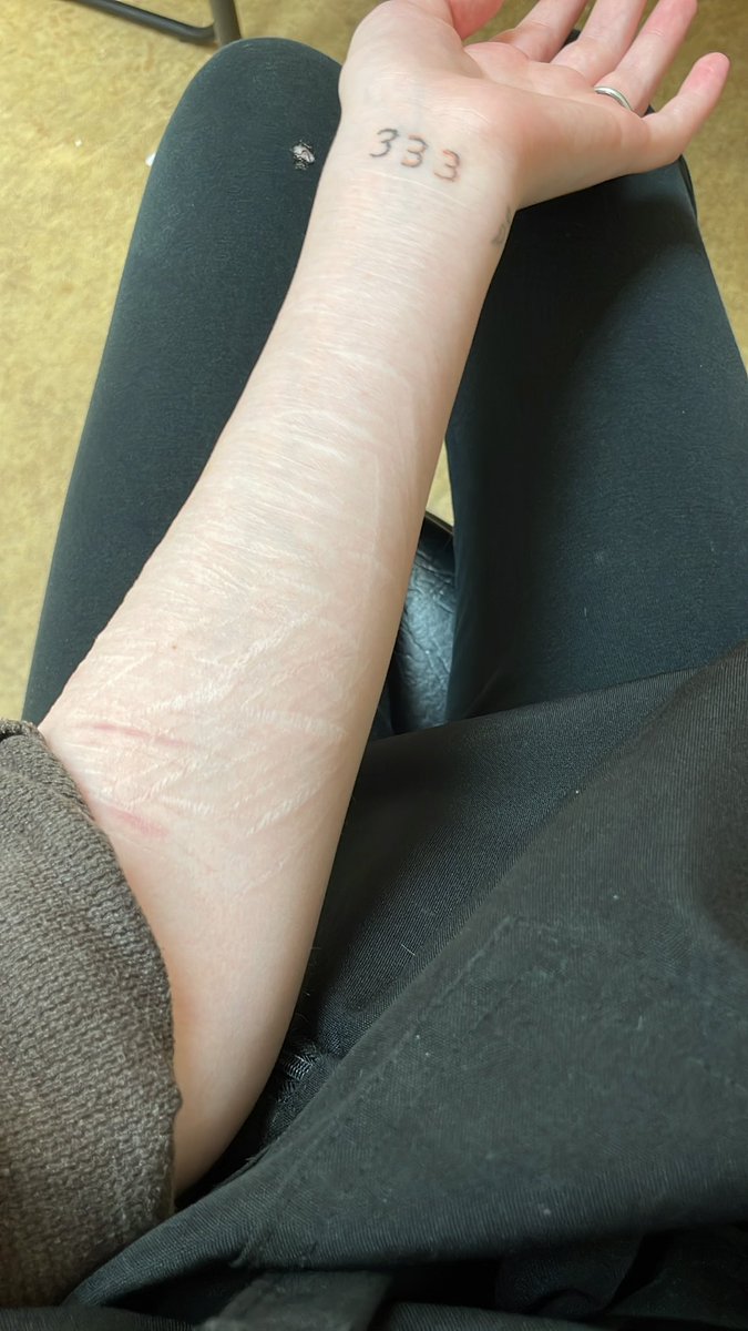 anaa_de4dgirl's tweet photo. #shedtwt i haven’t cut myself in about 2 years now, i’m 19 years old and i thought i outgrew that but ive been really tempted to start SH again. i want to see how deep i can go after years of not wanting to SH, what should i do?#shed #shtwt #edtwt #slit #sh #selfmutilation #scar https://t.co/IWzNLjYumj