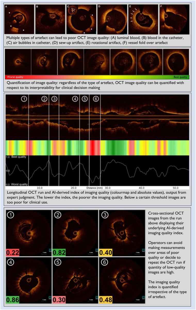 MyJSCAI (@myjscai) on Twitter photo 🆕Can AI Capture and Quantify Clinical Expertise?🤖💡
The authors present a futuristic view of the application of #AI by capturing the experts’ gestalt to better inform #decision-making. Read more from #JSCAI's AI Special Issue📚
➡️doi.org/10.1016/j.jsca…
<a href="/DanielChamie/">Daniel Chamié</a> 🆕Can AI Capture and Quantify Clinical Expertise?🤖💡
The authors present a futuristic view of the application of #AI by capturing the experts’ gestalt to better inform #decision-making. Read more from #JSCAI's AI Special Issue📚
➡️doi.org/10.1016/j.jsca…
<a href="/DanielChamie/">Daniel Chamié</a>