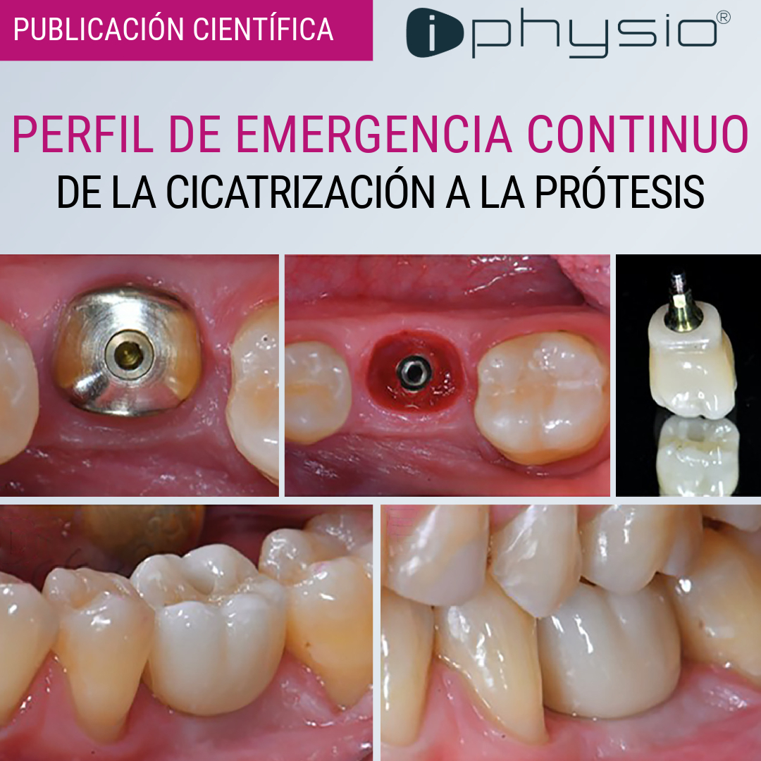 🔎​ Para preservar los tejidos blandos y evitar cualquier compresión de los tejidos, el perfil de emergencia creado durante la cicatrización de los tejidos blandos se mantiene en la restauración final.

Para más información ⬇️
 lyraetk.com/es/bibliotecas…

Simple. Safe. Accessible 😊