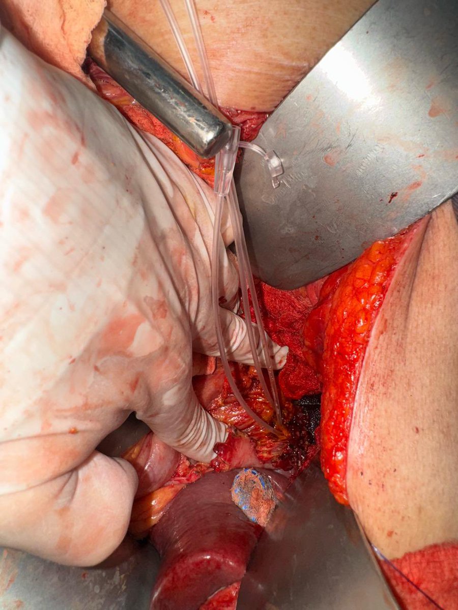 Carlos Rey (@carlosreey) on Twitter photo Bile tract reconstruction: Hepaticojejunostomy-HeppCouinaud technique.
Right hepatic duct, Left Hepatic duct, and Anterior Right sectorial hepatic duct
<a href="/HPBSabogal/">Cirugía Hepatobiliar Y Pancreatica(JCSO)HPBSurgery</a> <a href="/SimonMoros/">Simón Andrés Moros</a> Bile tract reconstruction: Hepaticojejunostomy-HeppCouinaud technique.
Right hepatic duct, Left Hepatic duct, and Anterior Right sectorial hepatic duct
<a href="/HPBSabogal/">Cirugía Hepatobiliar Y Pancreatica(JCSO)HPBSurgery</a> <a href="/SimonMoros/">Simón Andrés Moros</a>