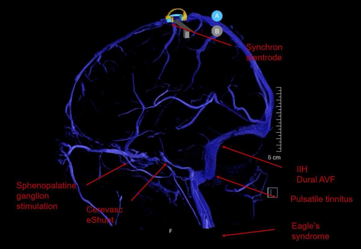 Visish M. Srinivasan, MD (@visishs) on Twitter photo With all the new potential applications for venous disease, it's even more important to get better imaging of the dural venous sinuses in the angio suite
Happy to present our new technique for "direct 3D rotational venography" <a href="/INR_WFITN/">Interventional Neuroradiology</a> With all the new potential applications for venous disease, it's even more important to get better imaging of the dural venous sinuses in the angio suite
Happy to present our new technique for "direct 3D rotational venography" <a href="/INR_WFITN/">Interventional Neuroradiology</a>