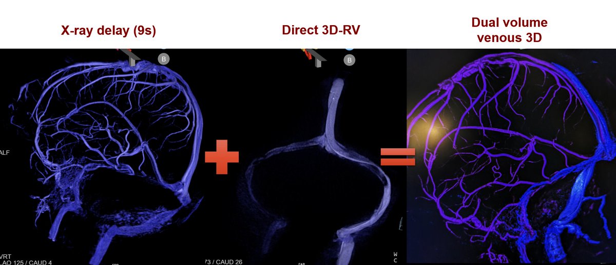 Visish M. Srinivasan, MD (@visishs) on Twitter photo These techniques are actually complimentary...
<a href="/cvsection/">CV Section</a> <a href="/SNISinfo/">SNIS Info</a> <a href="/JanKarlBurkhar1/">Jan-Karl Burkhardt, MD</a> <a href="/JCatapanoMD/">Joshua Catapano</a>
<a href="/_AdnanSiddiqui/">Adnan H. Siddiqui, MD</a> you can think of this as "mapping the venous frontier" These techniques are actually complimentary...
<a href="/cvsection/">CV Section</a> <a href="/SNISinfo/">SNIS Info</a> <a href="/JanKarlBurkhar1/">Jan-Karl Burkhardt, MD</a> <a href="/JCatapanoMD/">Joshua Catapano</a>
<a href="/_AdnanSiddiqui/">Adnan H. Siddiqui, MD</a> you can think of this as "mapping the venous frontier"