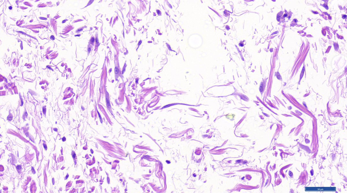 Beautiful and scary ganglion-like fibroblasts in proliferative fasciitis