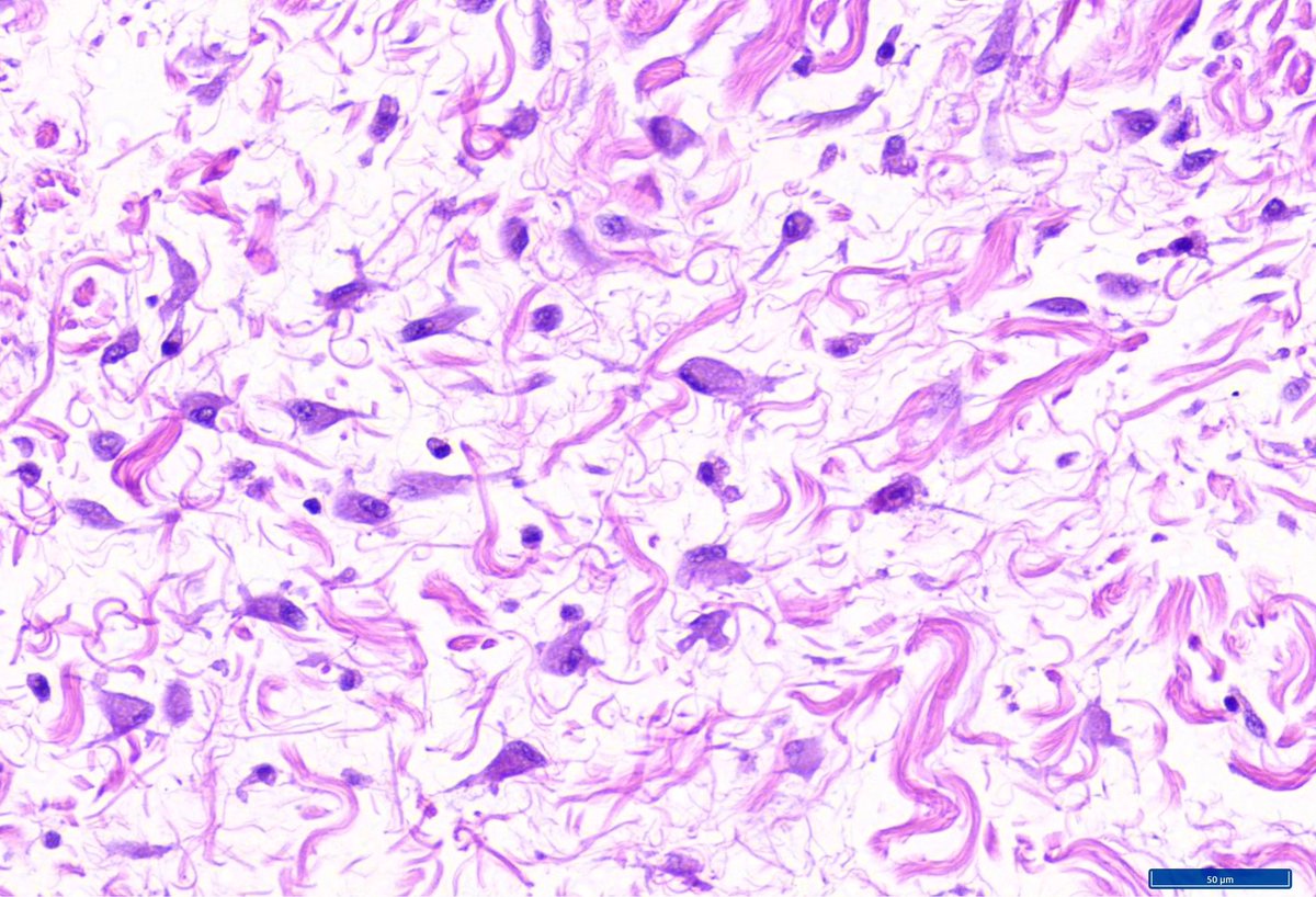 Hashimoto__0's tweet image. Beautiful and scary ganglion-like fibroblasts in proliferative fasciitis
