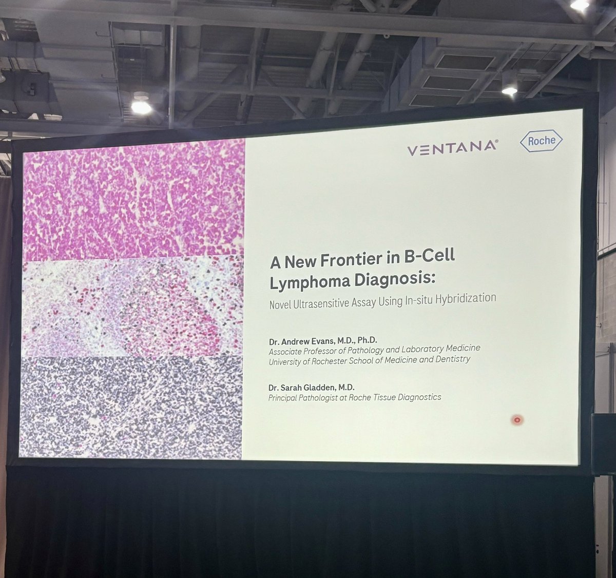 Dr. Andrew Evans, “Exhibitor Seminar: Roche - A new frontier in B-Cell Lymphoma diagnosis: Novel ultra sensitive assay using in-situ hybridization”
#PathTwitter 
#PathX 
#Pathology 
#USCAP2025
<a href="/TheUSCAP/">USCAP</a>
#pathresidency #pathologyresidency
#path2path