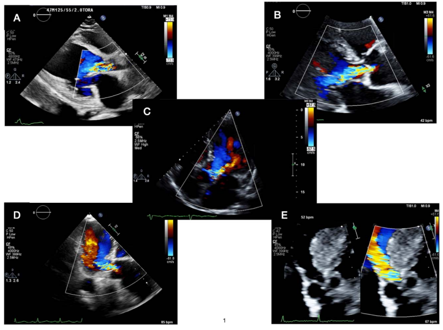 David_Ouyang's tweet photo. 1/n Excited to announce work by Dr. @BinderRodriguez from @MedUni_Wien on the AI automated assessment of Aortic Regurgitation (AR) on #echofirst using 59,500 videos from @SmidtHeart. Lead by Dr. Bob Siegel. https://t.co/cgOsgIxcUl