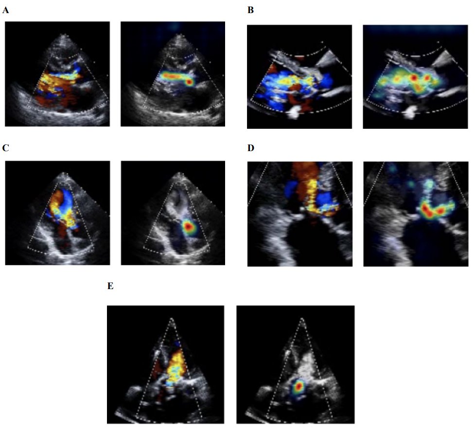 David_Ouyang's tweet photo. @BinderRodriguez @MedUni_Wien @SmidtHeart @milos_ai @Paul_P_Cheng @StanfordDeptMed 3/n Without additional prompting, our #echofirst model naturally gravitates towards the vena contracta in color Doppler videos to assess AR severity. https://t.co/9qMmMK7cRC