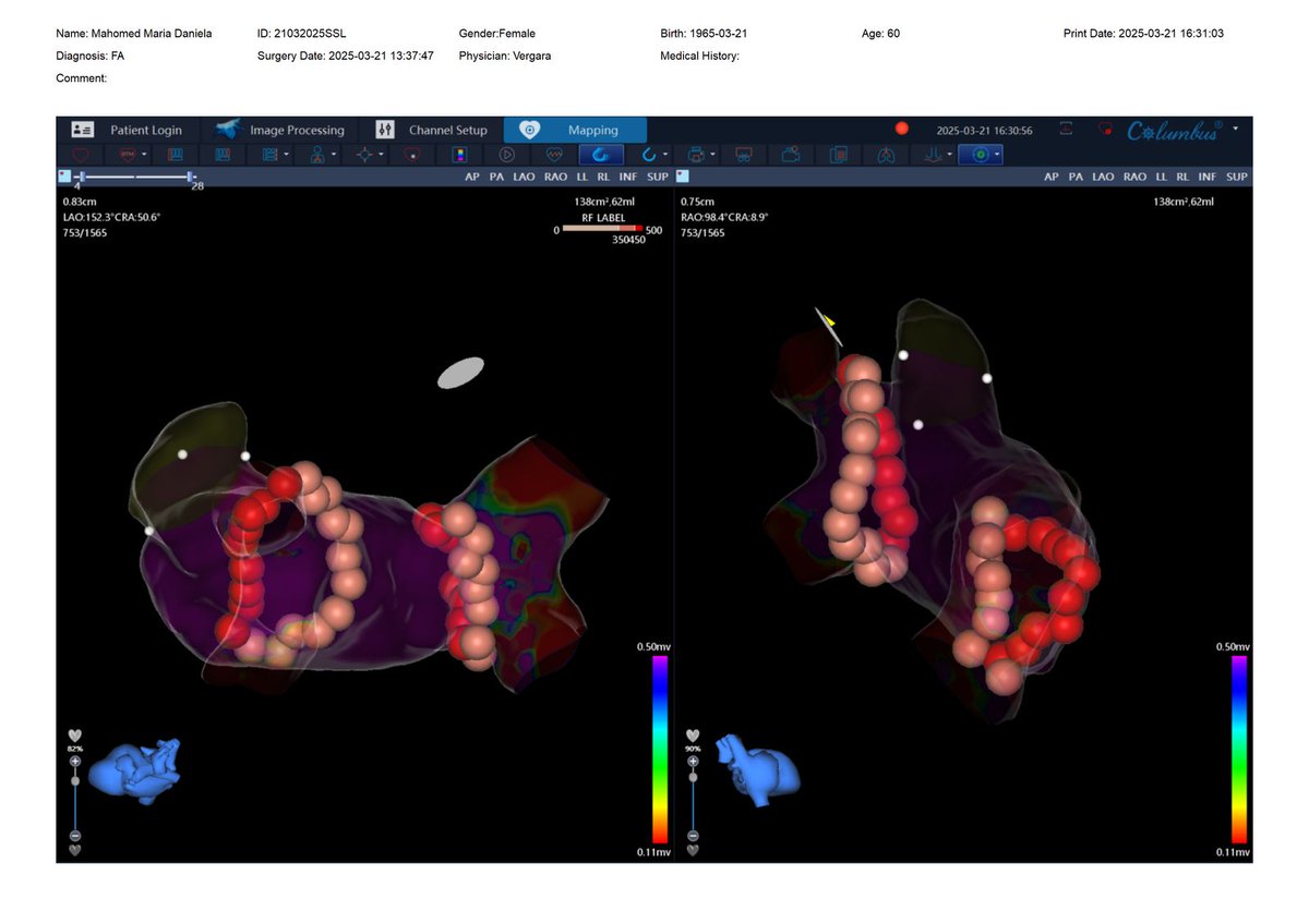 Hey <a href="/MicroPort/">MicroPort</a>! Well done! I was able to use your Columbus V4.5 3D nav syst for the first time, and I want to congratulate you. Your EasyStar multipoint catheter feels very comfortable to use, and your Trueforce catheter is really good. Congrats, <a href="/DiegoLeibman/">Diego Leibman</a> and <a href="/cokecalamar/">Rodrigo Gándara</a>