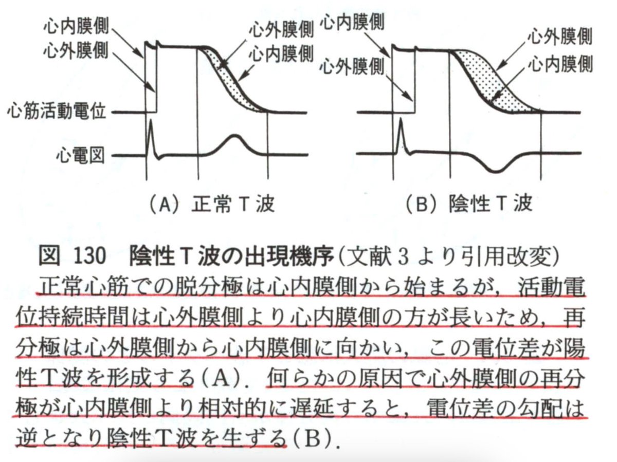 makkyecg's tweet photo. 心電図検定試験の対策本が沢山出版されて心電図を勉強する方が増えるのはとても良いことだと思います☺️しかし20年以上前に出版された書籍にも応用の効くロジックが明瞭に記載されています☺️僕はこれを読むまでAPHで何故巨大陰性T波が形成されるのか知りませんでした😭APH➡️GNTと丸覚えしてました🥹💦🥶 https://t.co/HyMkWNH25l
