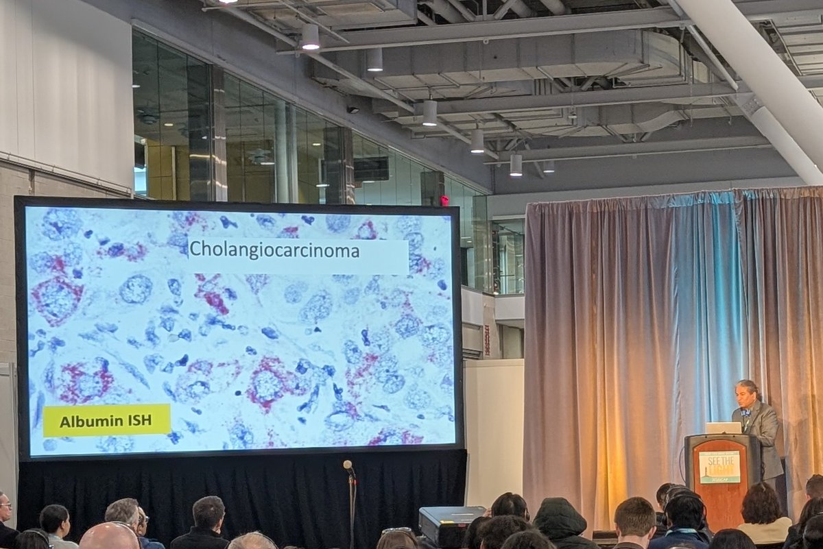 Swati Bhardwaj, MD (@drswatibhardwaj) on Twitter photo Dr. Vikram Deshpande <a href="/Vik_deshpandeMD/">Vikram Deshpande</a> highlighting the power of albumin ISH in liver tumor diagnosis <a href="/BIDMCpath/">BIDMC Pathology</a> <a href="/JClinPath_BMJ/">JClinPath_BMJ</a> #USCAP2025 Dr. Vikram Deshpande <a href="/Vik_deshpandeMD/">Vikram Deshpande</a> highlighting the power of albumin ISH in liver tumor diagnosis <a href="/BIDMCpath/">BIDMC Pathology</a> <a href="/JClinPath_BMJ/">JClinPath_BMJ</a> #USCAP2025