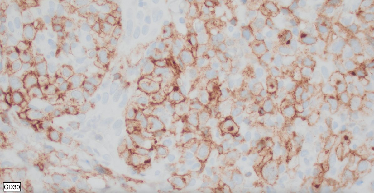Cutaneous T-cell lymphoma-NOS mimicking ALCL at relapse: Anaplastic T-cells with CD30 expression

#hemepath #lymsm #dermpath #Surgpath #PathX #PathTwitter #MedEd #MedX #Medtwitter