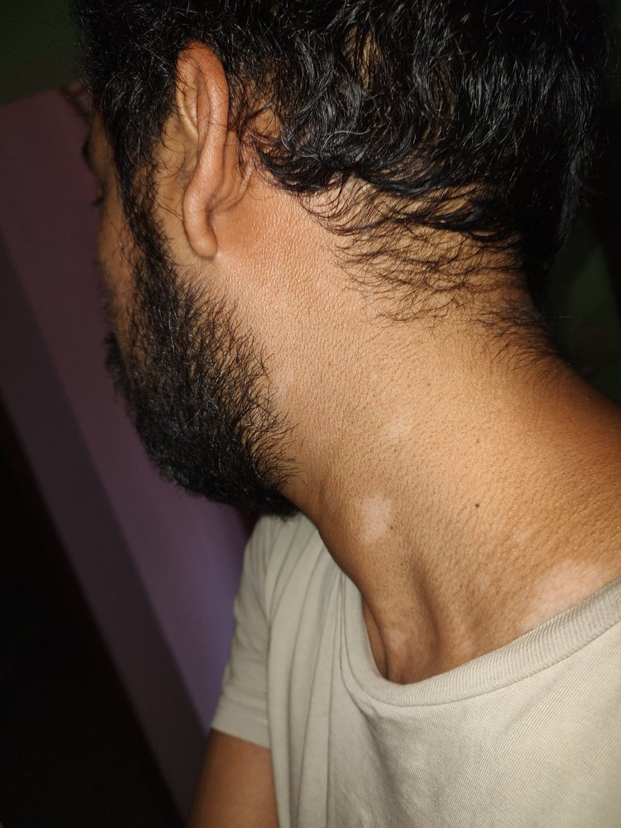 negativetaurus's tweet photo. K-brones les tengo que compartir algo, hace un par de semanas comencé a notar un par de manchas blancas en el pecho y parte de mi cuello, como no sentía molestia no le di importancia hasta que noté que se estaban extendiendo hasta mis brazos, fui con una dermatóloga... https://t.co/NuzRXsGQsH