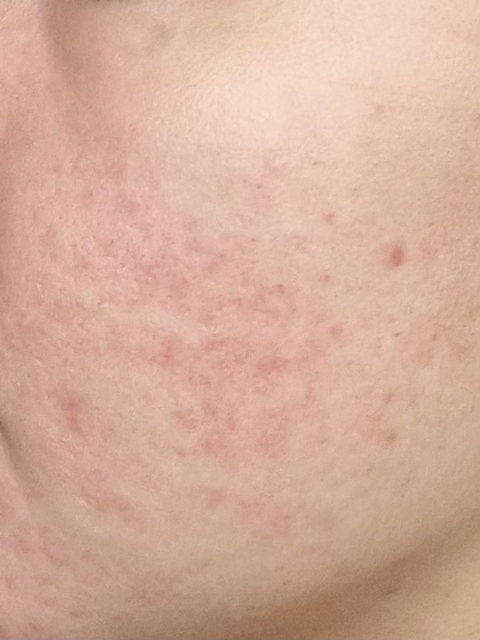 cloudysnowys's tweet photo. udah paling bener back to basic kalau kulit lagi merah merah iritasi atau kulitnya kering 

5 HARIAN REDNESS UDAH MEREDA...happy cuma pakai 1 skincare aja 🥹👍🏻 https://t.co/OqzFjB0PET