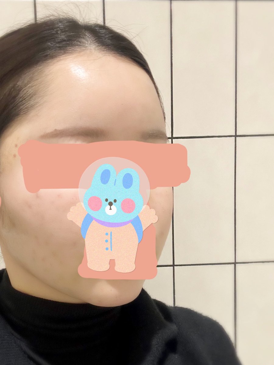 dezzztm's tweet photo. ザビビさんで脂肪移植をして1週間経ったのでレポです！ https://t.co/34YWL9Zbl7