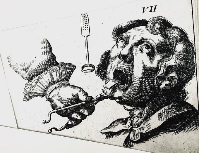 Johannes Scultetus was one of the first academically trained surgeons in Germany. His 17thc textbook on surgery was published after his death and contained many instruments of his own design, including this rather alarming looking jaw clamp