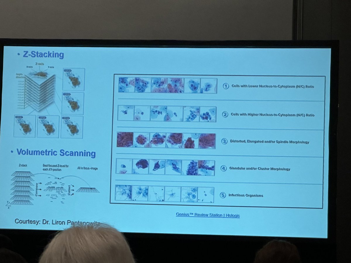 Judy (Qiuying) Shi, MD. (@judyshi8) on Twitter photo Cytopathology platform session: alwsys have surprising topic to learn from <a href="/JudyShi8/">Judy (Qiuying) Shi, MD.</a> #TheUSCAP <a href="/GokozanMD/">Hamza Numan Gokozan</a> <a href="/PoonamVohra3/">Poonam Vohra MD</a> <a href="/Baskotacytopath/">Swikrity U Baskota,MD, FCAP</a> <a href="/IACytology/">International Academy Cytology</a> Cytopathology platform session: alwsys have surprising topic to learn from <a href="/JudyShi8/">Judy (Qiuying) Shi, MD.</a> #TheUSCAP <a href="/GokozanMD/">Hamza Numan Gokozan</a> <a href="/PoonamVohra3/">Poonam Vohra MD</a> <a href="/Baskotacytopath/">Swikrity U Baskota,MD, FCAP</a> <a href="/IACytology/">International Academy Cytology</a>
