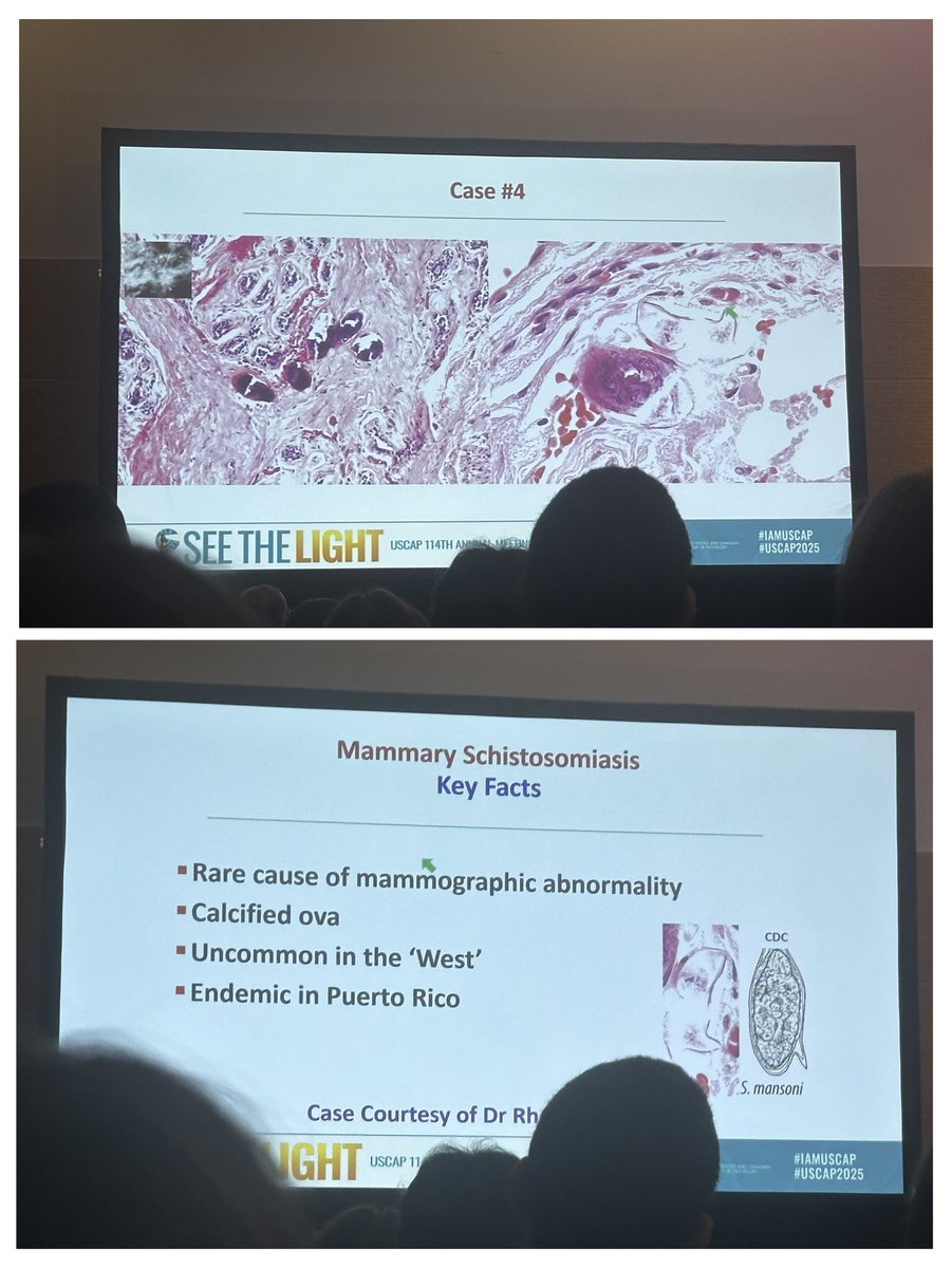 Can you believe a parasite can invade the breast? Mammary schistosomiasis—rare, fascinating, and a reminder that parasites know no boundaries! #breast #pathology #USCAP2025