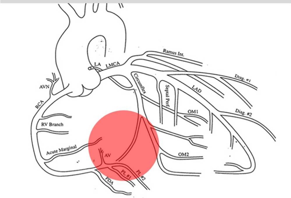 TrackYourHeart's tweet photo. What determines coronary artery dominance?

A) Size of the coronary artery; right-dominant in ~85% of cases
B) Artery giving rise to PDA; left-dominant in ~15% of cases
C) Artery giving rise to PDA; codominant in ~15% of cases
D) Artery giving rise to AV node; right-dominant in ~85% of cases
E) Artery giving rise to PDA; right-dominant in ~85% of cases

Comment your answer below