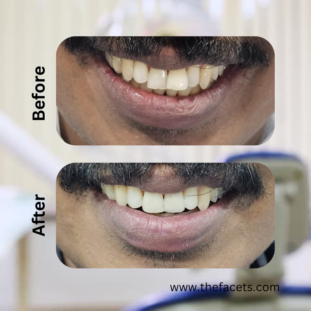 Get your smile enhanced with tooth-colored composite resin bonding/ filling.

Get your teeth gap filled from Facets Cosmetic and Restorative Dental Kochi, Kerala. One of the best dental clinic in Kochi with 25 years of excellence and Trust.

Call/ Whatsapp: +91 90 20 160 160