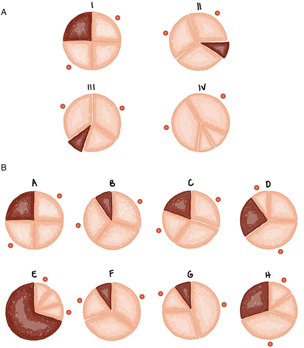 REC Publications (@revespcardiol) on Twitter photo Válvula aórtica cuadricúspide: una revisión de la literatura #reccardioclinics <a href="/Danilowere/">Danilo Weir Restrepo</a> reccardioclinics.org//es-valvula-ao… Válvula aórtica cuadricúspide: una revisión de la literatura #reccardioclinics <a href="/Danilowere/">Danilo Weir Restrepo</a> reccardioclinics.org//es-valvula-ao…