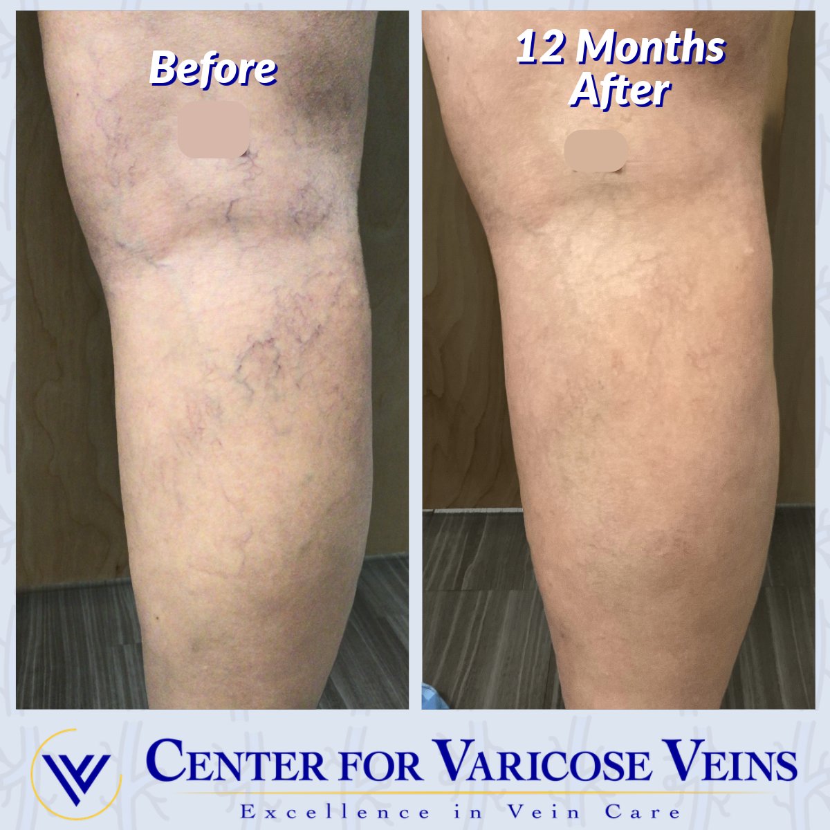 CenterMadan's tweet photo. 12 month results following minimally invasive varicose vein treatment including thermal ablation and sclerotherapy. Call 203-457-6226 to book an appointment at the Center for Varicose Veins. ⁠
⁠
#VaricoseVeinTreatment  #CenterforVaricoseVeins⁠
⁠
https://t.co/nAlRmFXDXM https://t.co/HdeFQTNaU3