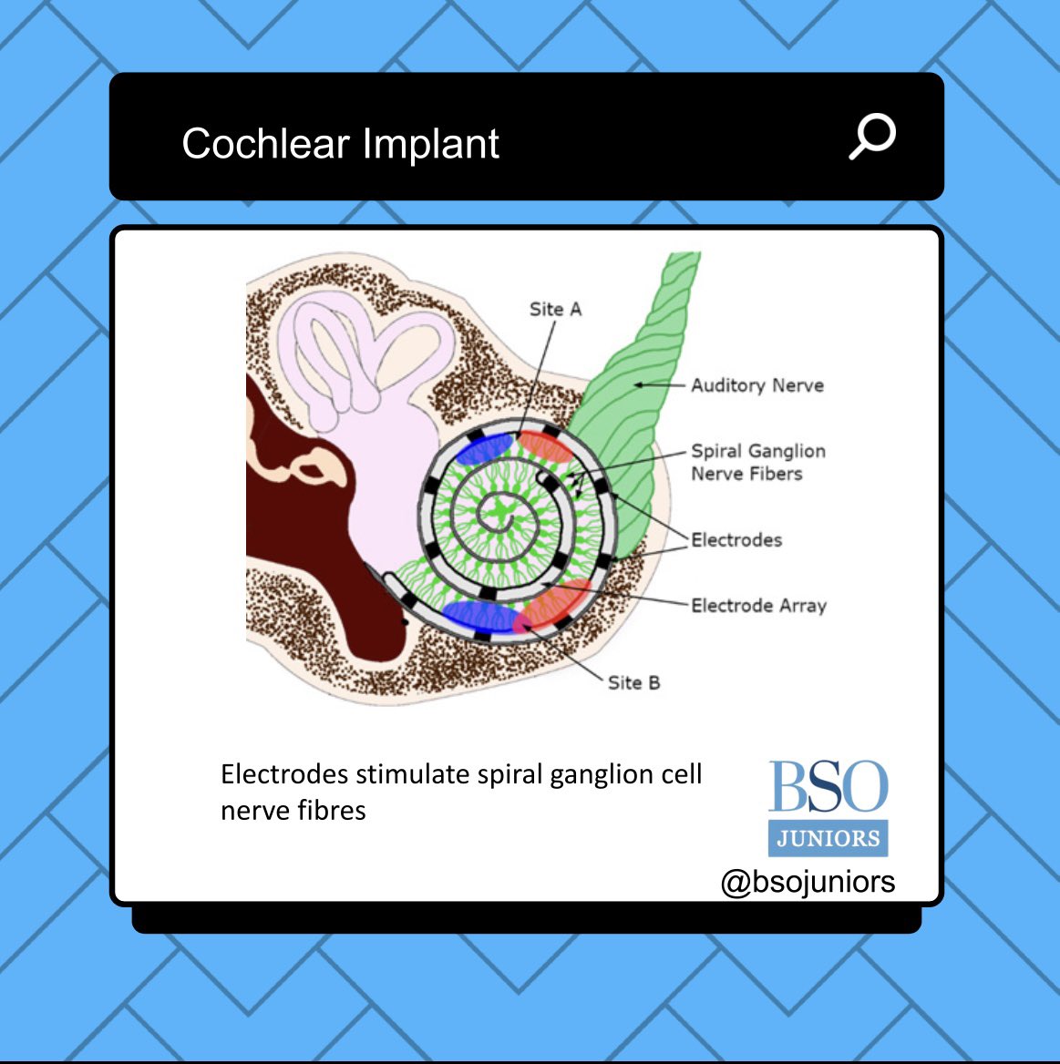 Cochlear Implant - Part 1

Cochlear Implants (CI): Transforming lives! 🦻✨ A solution for severe to profound hearing loss when hearing aids aren’t enough.