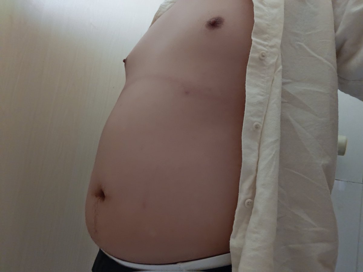Mo_Rui_D_A's tweet photo. Ordinary stomach #inflation #belly #ballbelly  #bigbelly https://t.co/yjmjJBUlS3