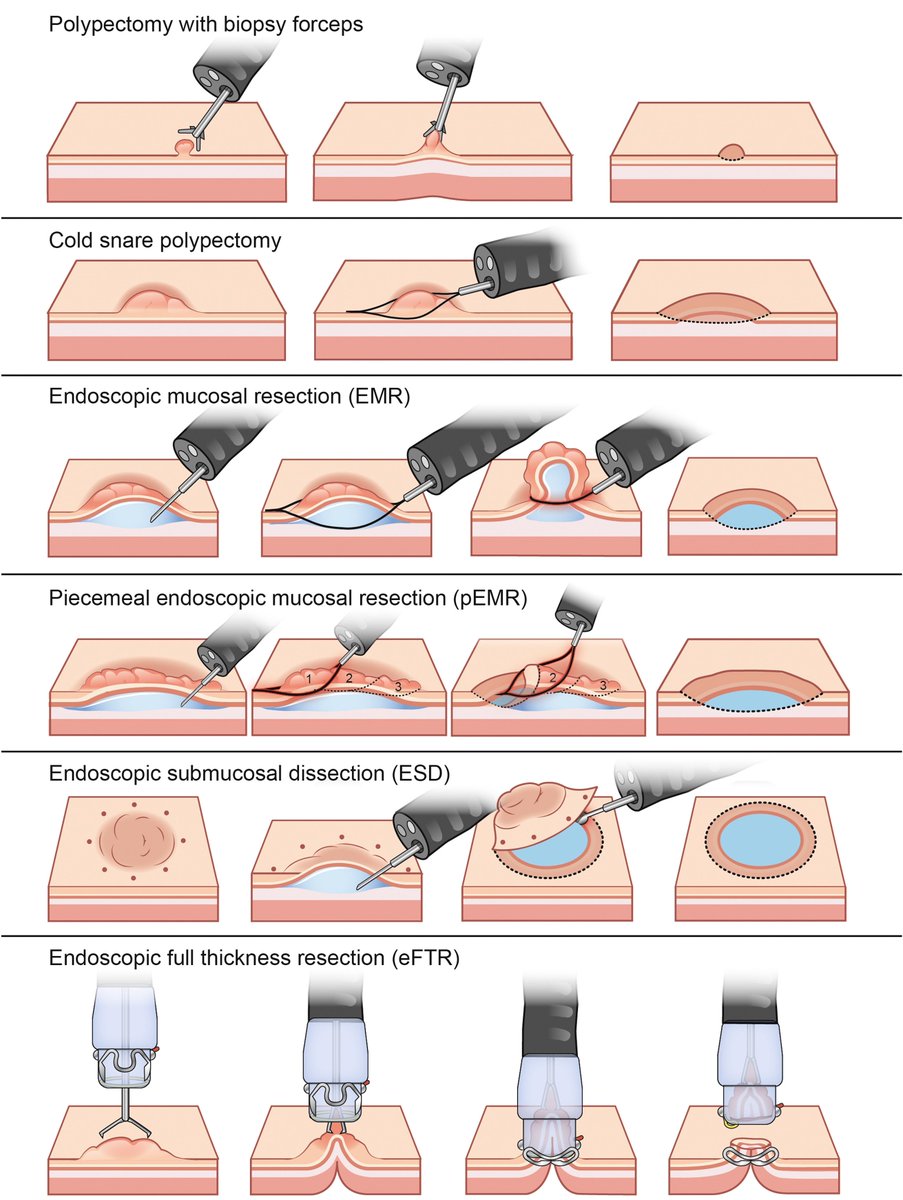 Hay muchas maneras de utilizar la endoscopia para extirpar un pólipo antes de que se convierta en cáncer. Estas son algunas de ellas. (via <a href="/AmerGastroAssn/">American Gastroenterological Association (AGA)</a>) 
Fuente: sciencedirect.com/science/articl…
#ColorectalCancerAwarenessMonth