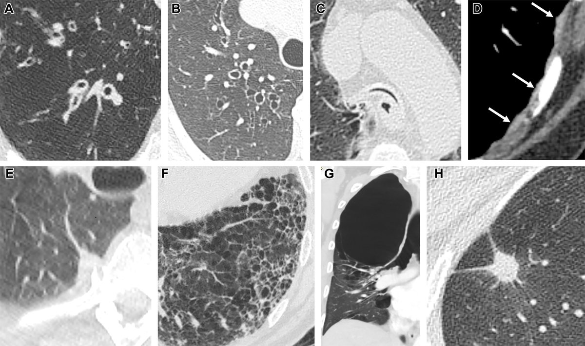RadioGraphics (@radiographics) on Twitter photo EBVs provide a minimally invasive option for severe emphysema, reducing hyperinflation & improving breathing. Learn how imaging plays a key role in treatment & monitoring! <a href="/cookyscan1/">Cooky Menias</a> @RadG_editor @TempleRADS bit.ly/4if6Zkt EBVs provide a minimally invasive option for severe emphysema, reducing hyperinflation & improving breathing. Learn how imaging plays a key role in treatment & monitoring! <a href="/cookyscan1/">Cooky Menias</a> @RadG_editor @TempleRADS bit.ly/4if6Zkt