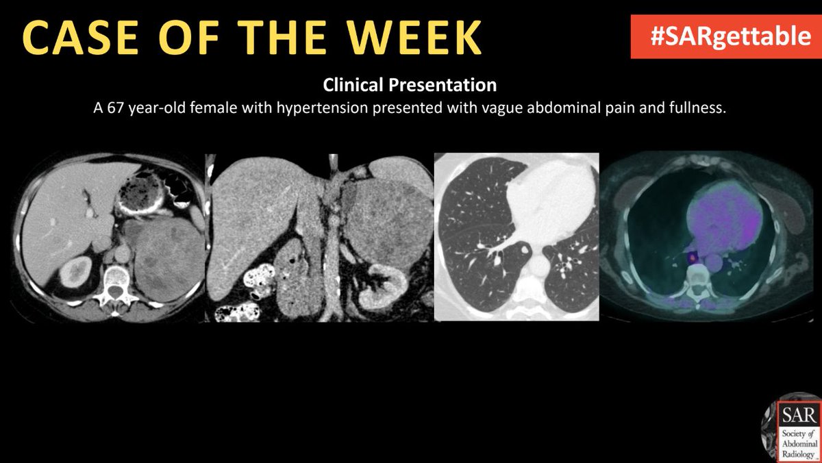 Society of Abdominal Radiology | SAR (@societyabdrad) on Twitter photo It's time for a new #SARgettable case of the week contributed by <a href="/ErinCookeMD/">Erin Cooke, MD</a>. Comment with your diagnosis down below! It's time for a new #SARgettable case of the week contributed by <a href="/ErinCookeMD/">Erin Cooke, MD</a>. Comment with your diagnosis down below!