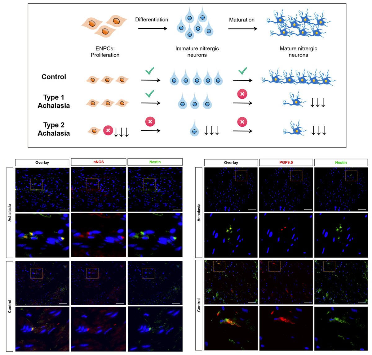Neurogastro & Motil (@ngmjournal) on Twitter photo 🆕🔥Differential #Neurogenesis status among #Achalasia subtypes‼️
🎯Status of neurogenesis varies based on #ENPCs counts, immature & mature #nitrergic axon innervation in #LES👏
✅Type 2 achalasia showed a more severe loss of ENPCs🔥
👉onlinelibrary.wiley.com/doi/10.1111/nm…
<a href="/ANMSociety/">ANMS</a> <a href="/esnm_eu/">ESNM.eu</a> 🆕🔥Differential #Neurogenesis status among #Achalasia subtypes‼️
🎯Status of neurogenesis varies based on #ENPCs counts, immature & mature #nitrergic axon innervation in #LES👏
✅Type 2 achalasia showed a more severe loss of ENPCs🔥
👉onlinelibrary.wiley.com/doi/10.1111/nm…
<a href="/ANMSociety/">ANMS</a> <a href="/esnm_eu/">ESNM.eu</a>