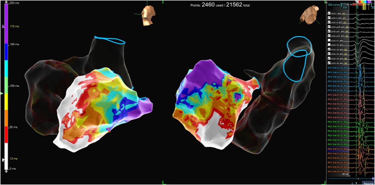 Heart Rhythm Case Reports (@hrs_casereports) on Twitter photo New Case for Education in the March issue!
Bipolar ablation from the right atrium and basal inferoseptal left ventricle to treat ventricular tachycardia arising from the inferoseptal process
<a href="/DanielAlyeshmer/">Daniel Alyesh</a>
Read the article and take the related quiz: heartrhythmcasereports.com/article/S2214-… New Case for Education in the March issue!
Bipolar ablation from the right atrium and basal inferoseptal left ventricle to treat ventricular tachycardia arising from the inferoseptal process
<a href="/DanielAlyeshmer/">Daniel Alyesh</a>
Read the article and take the related quiz: heartrhythmcasereports.com/article/S2214-…