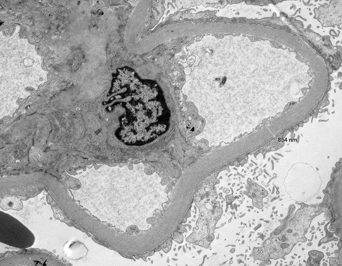 Diabetes vs primary podocytopathy as the cause of NS? Podocyte IgG dusting + diffuse FPE can be helpful features favoring the later. Pt had hx of primary FSGS prior to diabetic nephropathy. #renalpath #pathwittter #nephrology