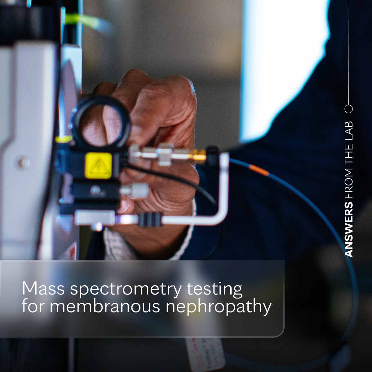 Mayo Clinic Labs (@mayocliniclabs) on Twitter photo Membranous nephropathy is an autoimmune disease that damages blood vessels in the kidneys. Our mass spectrometry test identifies 13 antigens known to cause the disease.
Learn more in this test-specific "Answers From the Lab" podcast with <a href="/SethiRenalPath/">Sanjeev Sethi</a>.
bit.ly/425FfZX Membranous nephropathy is an autoimmune disease that damages blood vessels in the kidneys. Our mass spectrometry test identifies 13 antigens known to cause the disease.
Learn more in this test-specific "Answers From the Lab" podcast with <a href="/SethiRenalPath/">Sanjeev Sethi</a>.
bit.ly/425FfZX