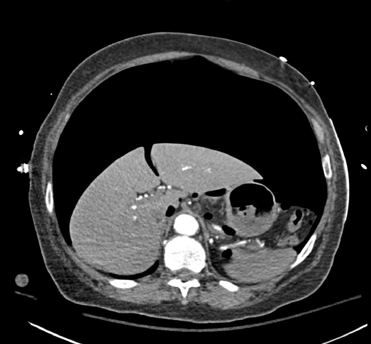 JEM Case of the Week Answer: CXR shows a tension pneumoperitoneum likely from initial esophageal intubation.  Read the full case here. #medtwitter <a href="/aaeminfo/">AAEM</a> <a href="/SLUEMRes/">SLU Emergency Medicine Residency</a>  jem-journal.com/article/S0736-…