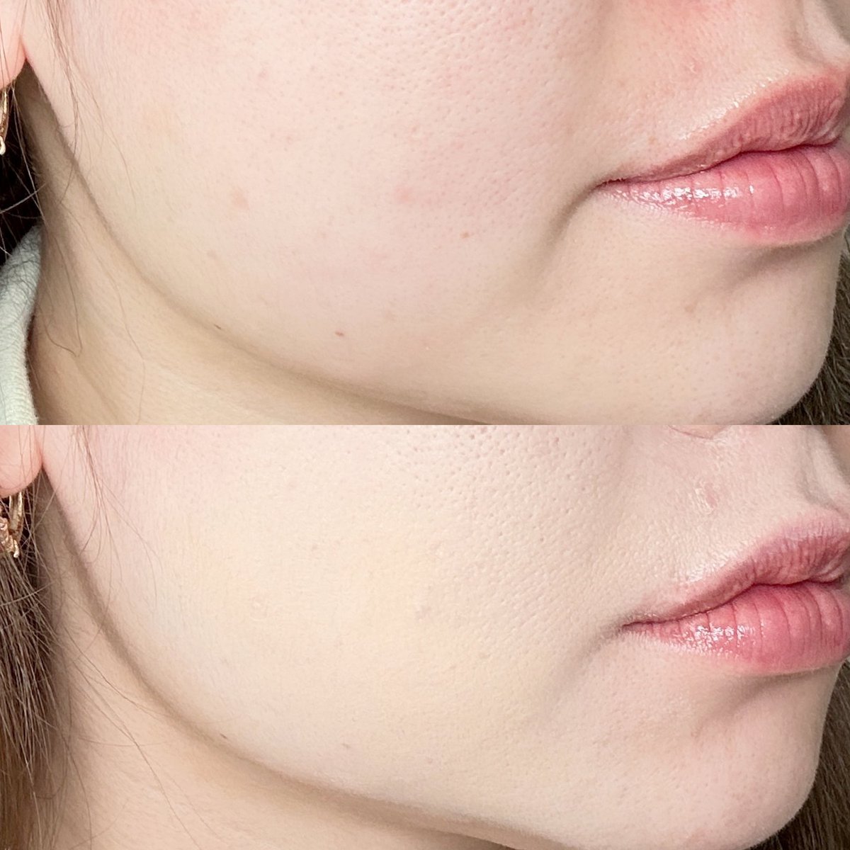 เรียลสุดๆ มาโชว์ความปกปิดขั้นเทพของ Skintific concealer 2 หัว 🩵 ปกปิดได้ทุกรอย รอยสิว รอยดำ นี่ทากับผิวจริง แบบไม่ลงรองพื้นเลย ฟินิชสวยมาก ไม่หนา ดูเป็นผิว มีหลายสีมาก จะเลือกใช้เป็นไฮไลท์ คอนทัวร์ก็ได้ #ใช้จริงรีวิวจริง #ใช้ดีบอกต่อ https://t.co/Q3WdCVdJwO