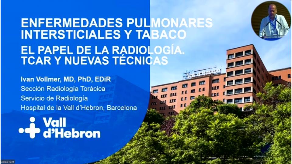 marcosmestas's tweet photo. Excelente bloque de "Enf. Pulmonar Intersticial y Tabaco"  en el Simposio EPI 2025 del @vallhebron 

Especially @smlungpathguy  masterclass, lung pathology made easy! I hope there will be a revision of terminology/definitions soon, it's about time

@Ivanvollmert  @SansanoValero https://t.co/D9P2cgHY0j
