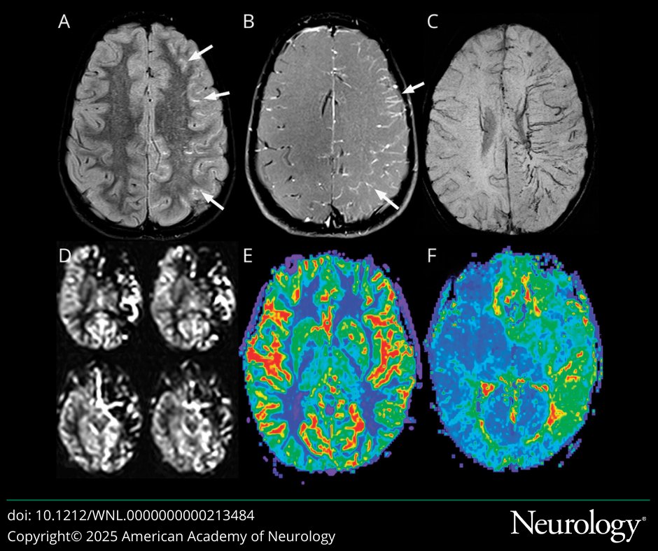 Moyamoya Across the Lifespan: Current Neurologic Care and Future Directions hubs.la/Q03bRswS0

#NeuroX