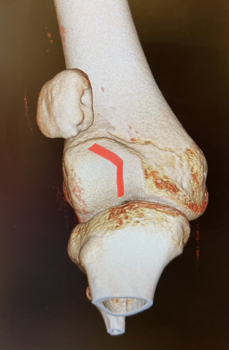 Move it to the groove. Joint preservation stabilization. No trochleoplasty