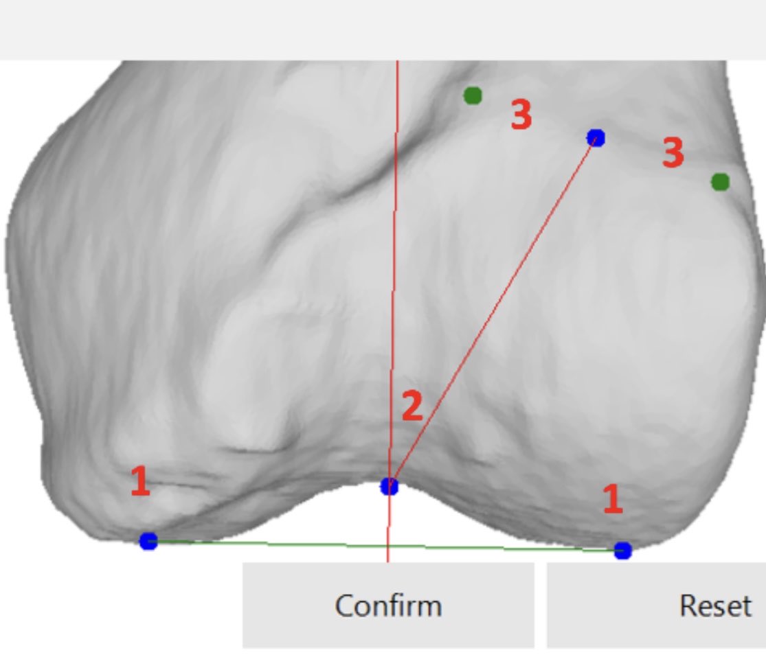 No trochleoplasty needed. Just move the patella so it becomes permanently stable