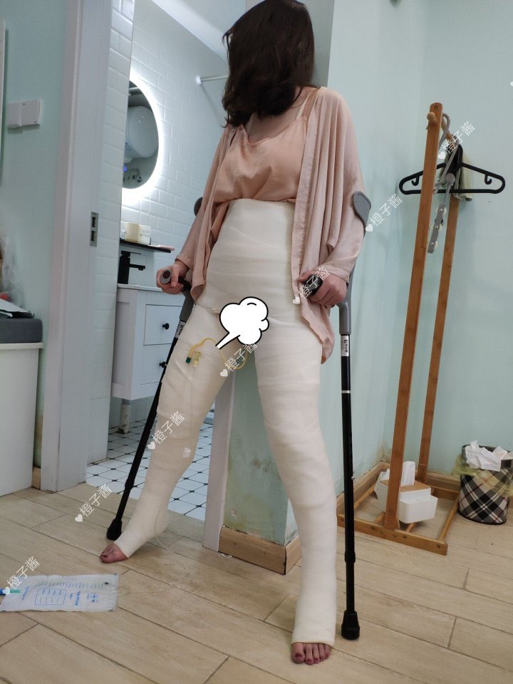 asiangips's tweet photo. forced to stand in a huge DHS cast😭
#hipspicacast #castedleg #longlegcast
#gips #castplaster #gesso #石膏绷带 #ギプス
full of 20pics on patreon https://t.co/5hvkfnJioI