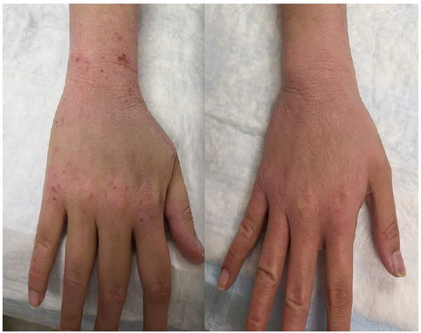 #ECZEMA NEWS: #TopicalSteroidWithdrawal (#TSW)—which results in dermatitis distinct from eczema—is caused by an excess of an essential compound in the body, according to a new #NIAID study, which identified possible treatments in a pilot study.  go.nih.gov/w8PmVDe